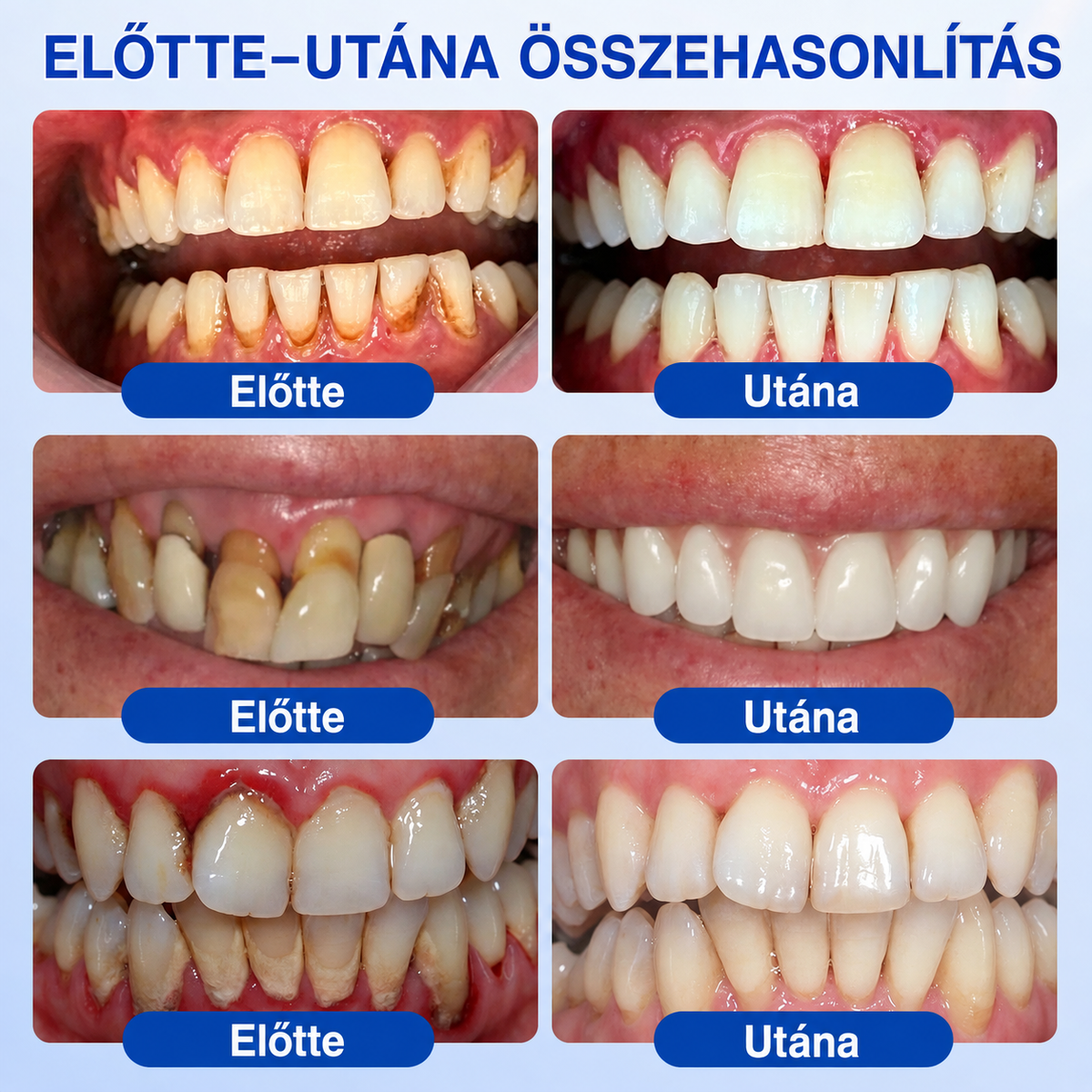 🥇𝑮𝒍𝒊𝒎𝒎𝒆𝒓𝒍𝒚®  ÍNYMEGÚJÍTÓ – Parodontális helyreállító gél