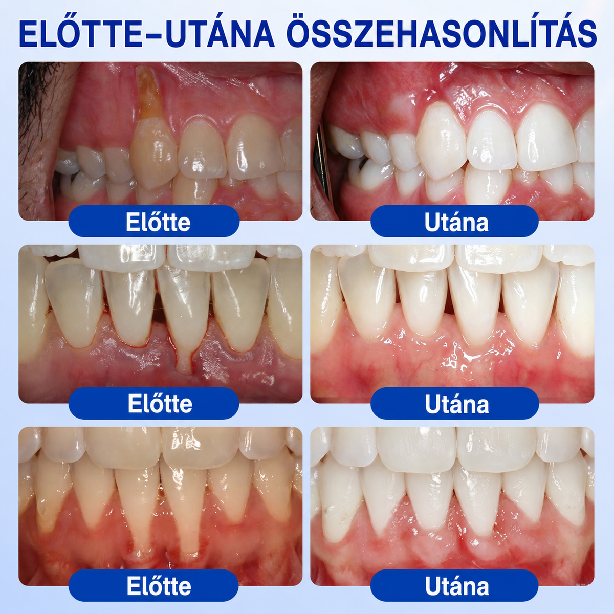 🥇𝑮𝒍𝒊𝒎𝒎𝒆𝒓𝒍𝒚®  ÍNYMEGÚJÍTÓ – Parodontális helyreállító gél