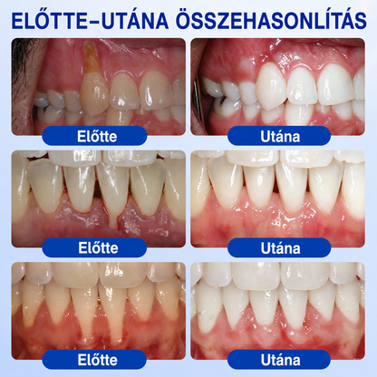 🥇𝑮𝒍𝒊𝒎𝒎𝒆𝒓𝒍𝒚®  ÍNYMEGÚJÍTÓ – Parodontális helyreállító gél